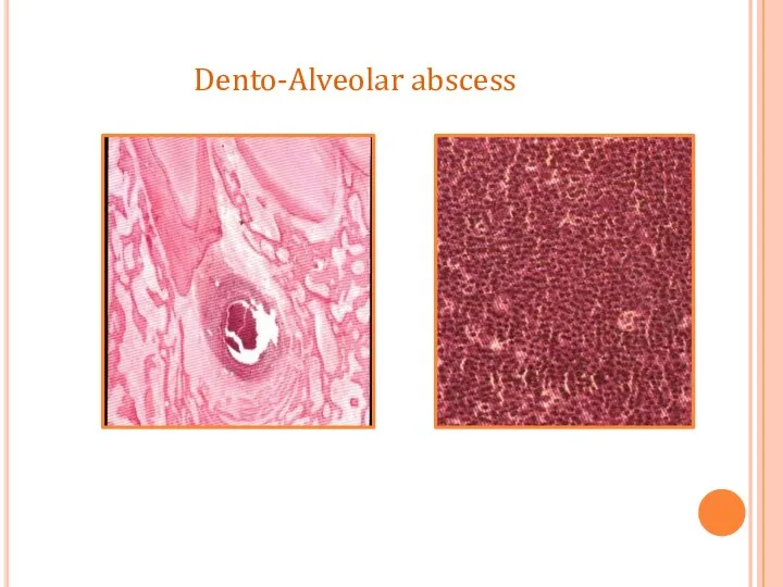 Dento-Alveolar abscess