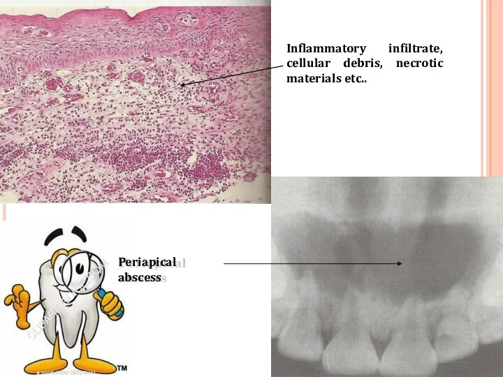 Periapical abscess Inflammatory infiltrate, cellular debris, necrotic materials etc..