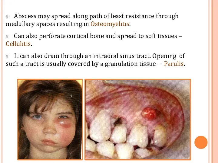 Abscess may spread along path of least resistance through medullary spaces resulting in