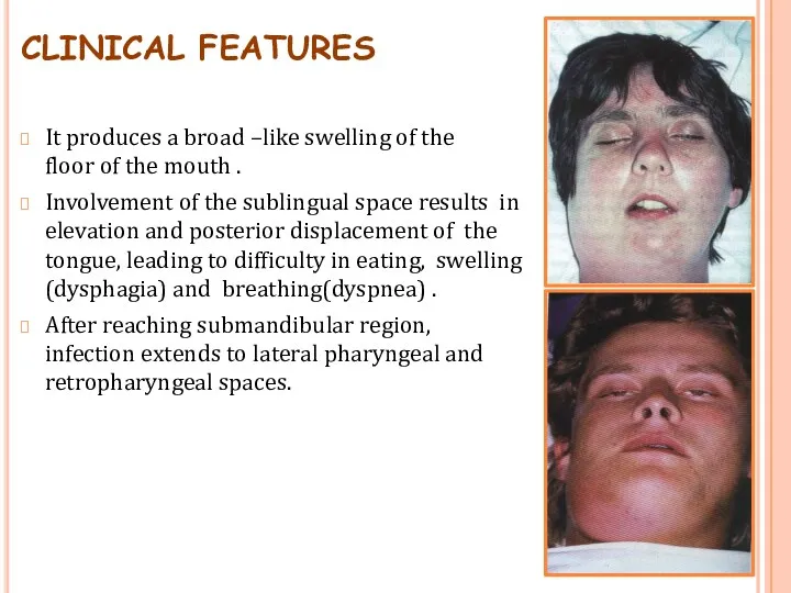 CLINICAL FEATURES It produces a broad –like swelling of the floor of the