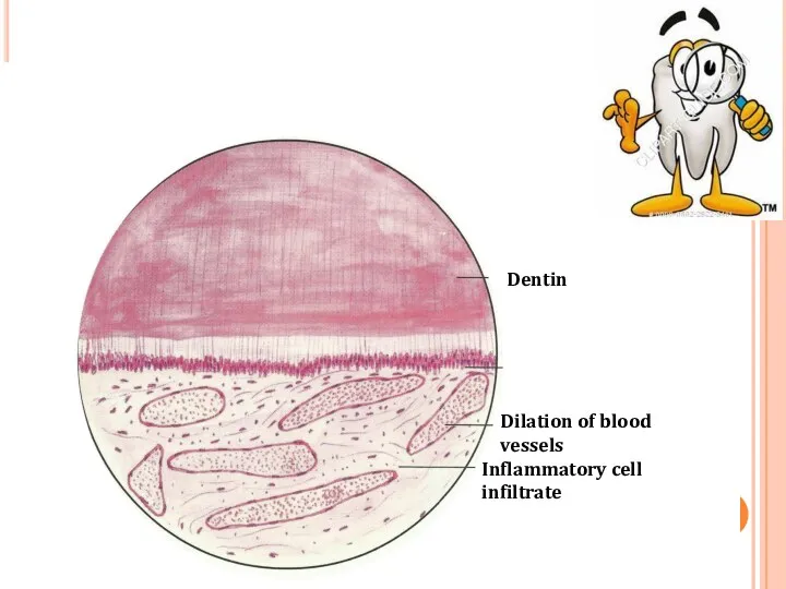 Dilation of blood vessels Inflammatory cell infiltrate Dentin