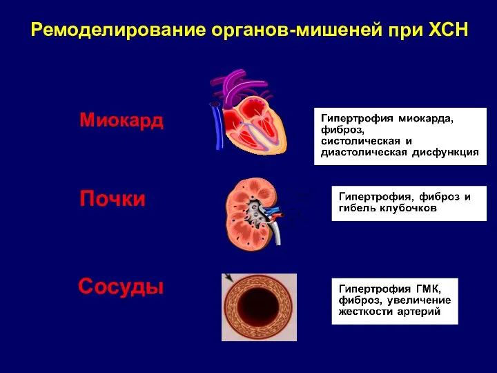 Миокард Почки Сосуды Ремоделирование органов-мишеней при ХСН