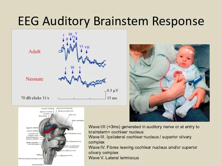 EEG Auditory Brainstem Response Wave I/II ( Wave III. Ipsilateral