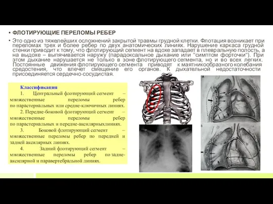 ФЛОТИРУЮЩИЕ ПЕРЕЛОМЫ РЕБЕР Это одно из тяжелейших осложнений закрытой травмы
