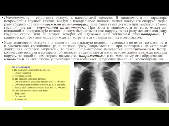 Пневмоторакс – скопление воздуха в плевральной полости. В зависимости от