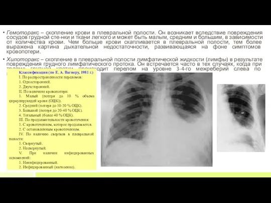 Гемоторакс – скопление крови в плевральной полости. Он возникает вследствие