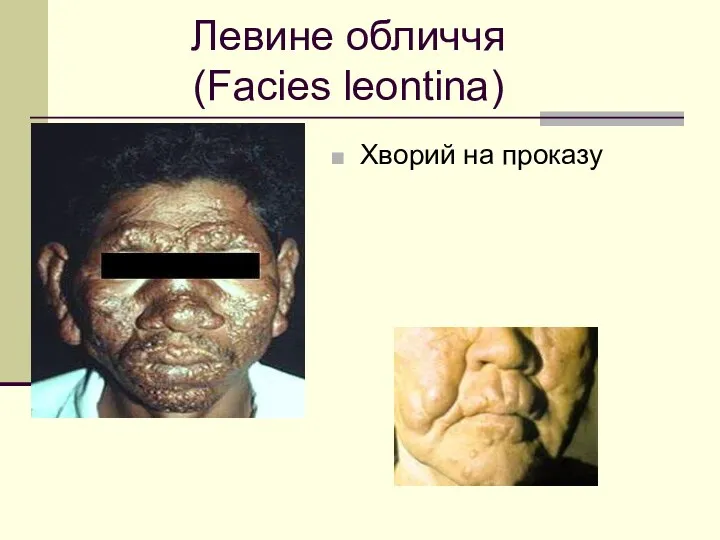 Левине обличчя (Facies leontina) Хворий на проказу