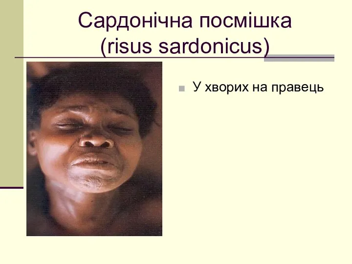 Сардонічна посмішка (risus sardonicus) У хворих на правець