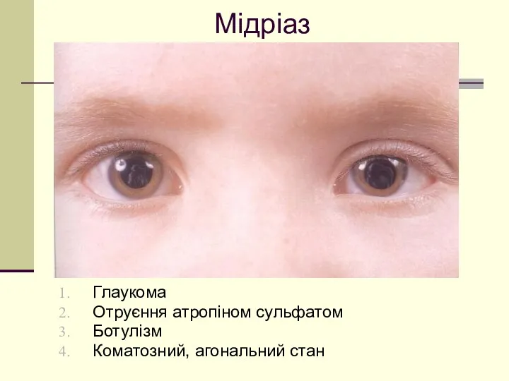 Мідріаз Глаукома Отруєння атропіном сульфатом Ботулізм Коматозний, агональний стан