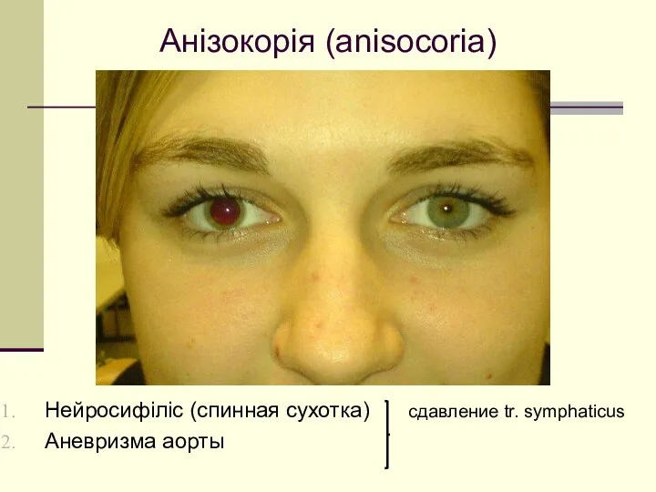 Анізокорія (anisocoria) Нейросифіліс (спинная сухотка) сдавление tr. symphaticus Аневризма аорты