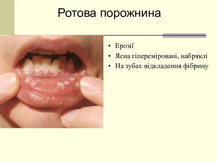 Ерозії Ясна гіпереміровані, набряклі На зубах відкладення фібрину Ротова порожнина