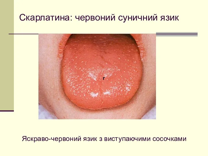 г Яскраво-червоний язик з виступаючими сосочками Скарлатина: червоний суничний язик