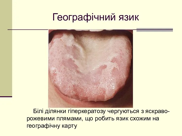 Географічний язик Білі ділянки гіперкератозу чергуються з яскраво-рожевими плямами, що робить язик схожим на географічну карту