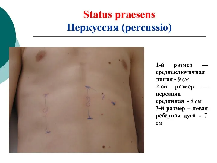 Status praesens Перкуссия (percussio) 1-й размер — среднеключичная линия - 9 см 2-ой
