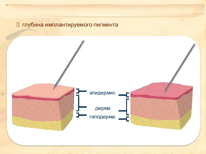 глубина имплантируемого пигмента эпидермис дерма гиподерма