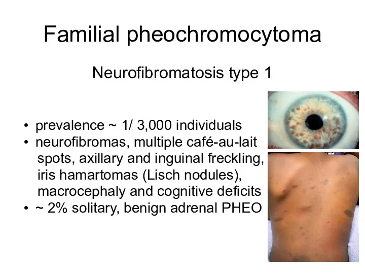 Familial pheochromocytoma Neurofibromatosis type 1 prevalence ~ 1/ 3,000 individuals neurofibromas, multiple café-au-lait