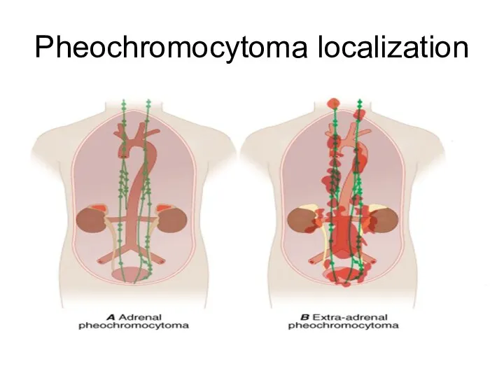Pheochromocytoma localization