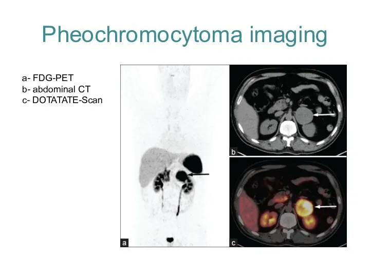 Pheochromocytoma imaging a- FDG-PET b- abdominal CT c- DOTATATE-Scan