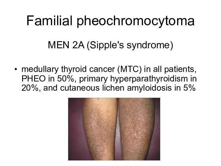 Familial pheochromocytoma MEN 2A (Sipple's syndrome) medullary thyroid cancer (MTC) in all patients,