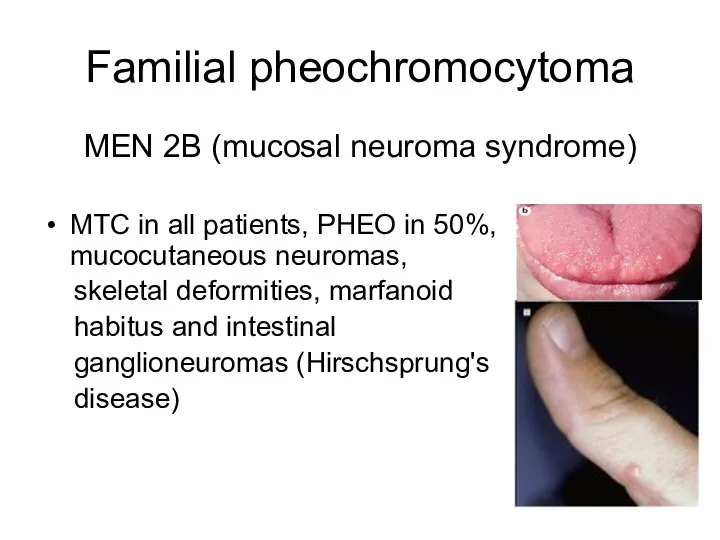 Familial pheochromocytoma MEN 2B (mucosal neuroma syndrome) MTC in all patients, PHEO in