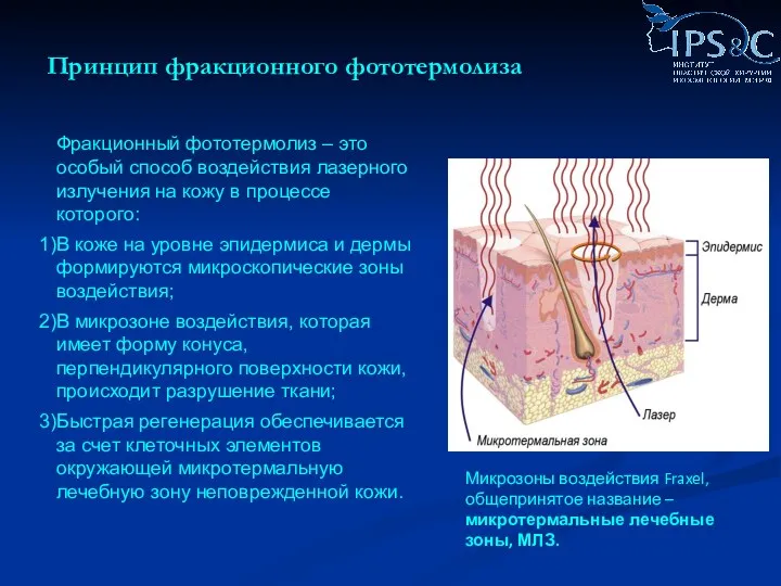 Принцип фракционного фототермолиза Фракционный фототермолиз – это особый способ воздействия