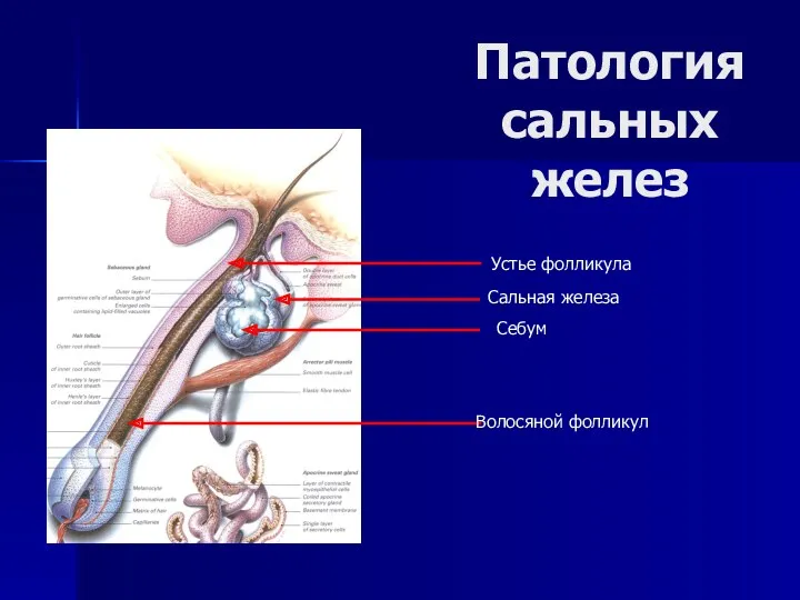 Патология сальных желез