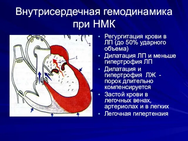 Внутрисердечная гемодинамика при НМК Регургитация крови в ЛП (до 50%