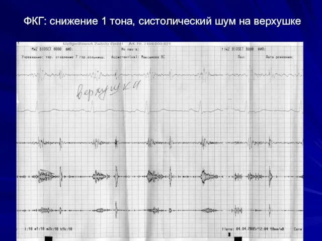 ФКГ: снижение 1 тона, систолический шум на верхушке