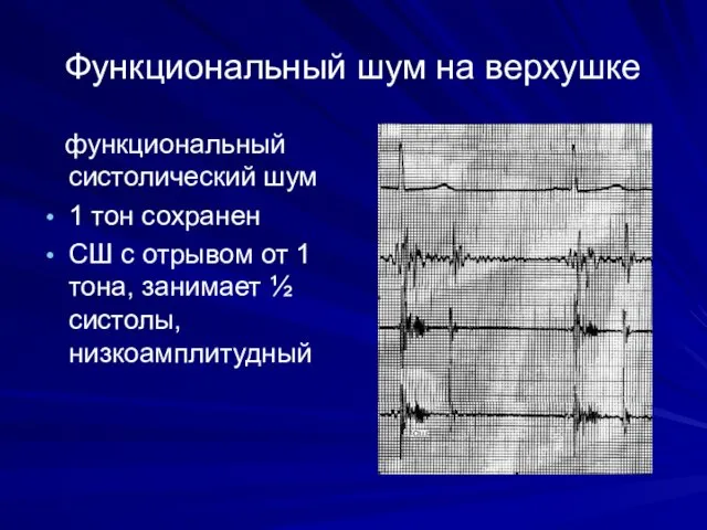 Функциональный шум на верхушке функциональный систолический шум 1 тон сохранен