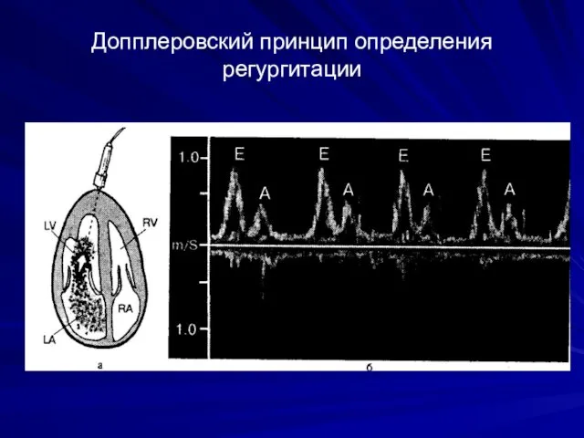 Допплеровский принцип определения регургитации