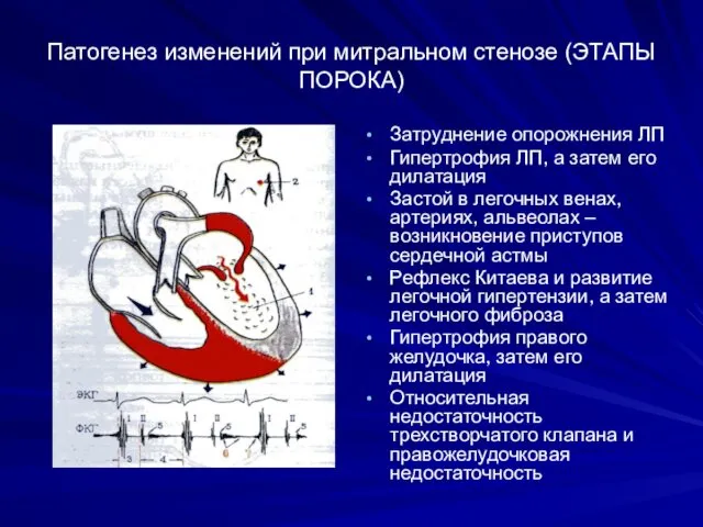 Патогенез изменений при митральном стенозе (ЭТАПЫ ПОРОКА) Затруднение опорожнения ЛП