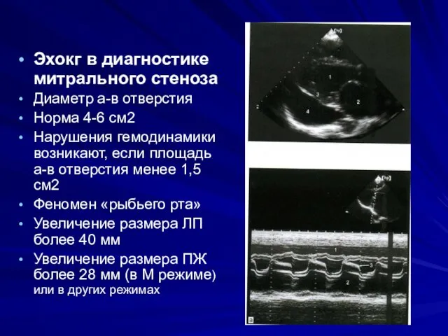 Эхокг в диагностике митрального стеноза Диаметр а-в отверстия Норма 4-6