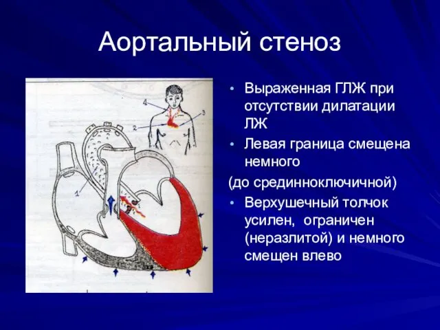 Аортальный стеноз Выраженная ГЛЖ при отсутствии дилатации ЛЖ Левая граница