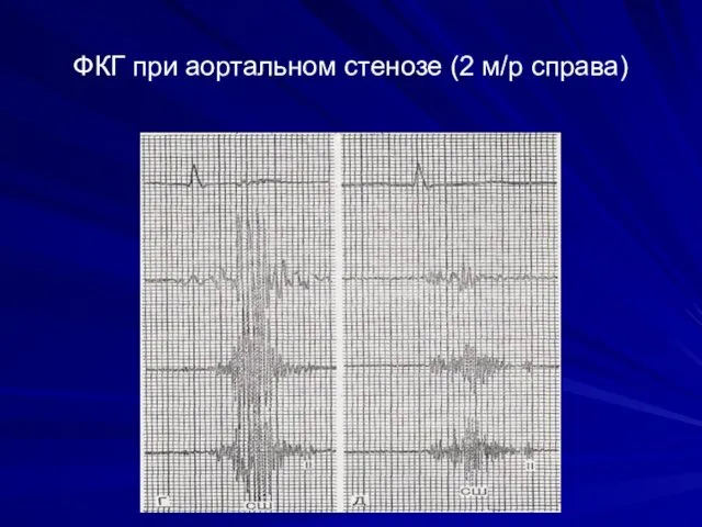 ФКГ при аортальном стенозе (2 м/р справа)