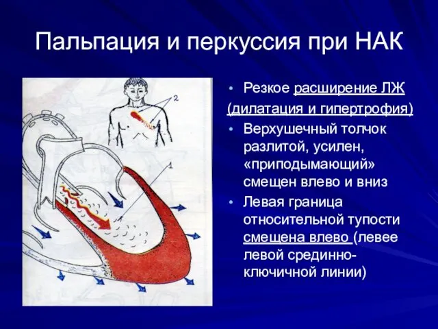 Пальпация и перкуссия при НАК Резкое расширение ЛЖ (дилатация и