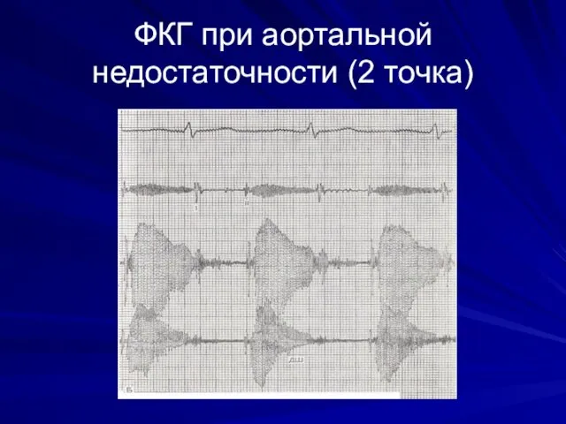 ФКГ при аортальной недостаточности (2 точка)