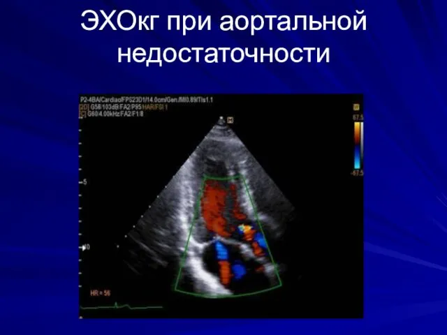 ЭХОкг при аортальной недостаточности