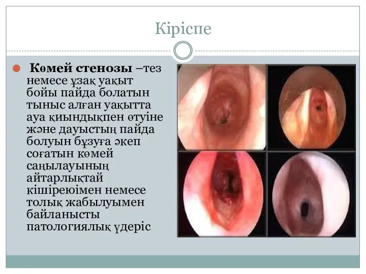 Кіріспе Көмей стенозы –тез немесе ұзақ уақыт бойы пайда болатын