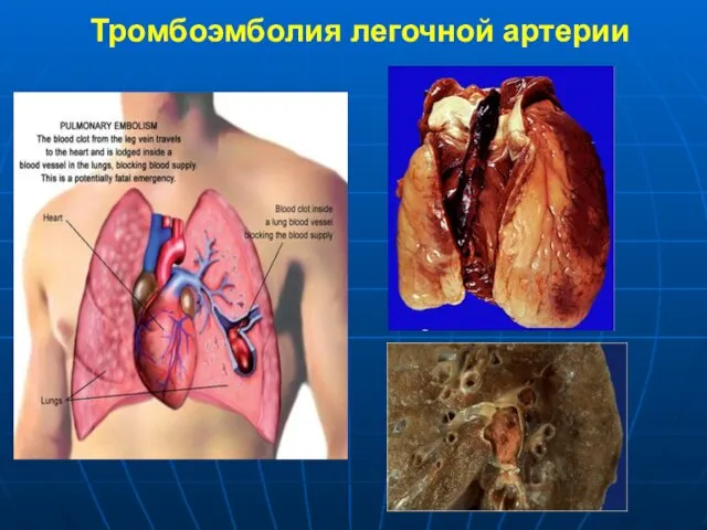 Тромбоэмболия легочной артерии