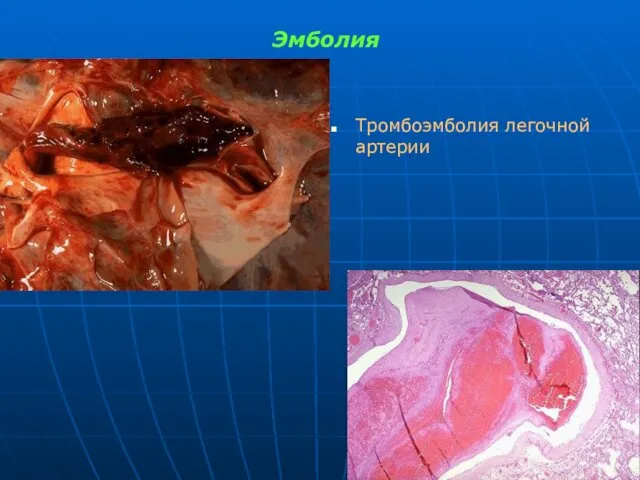 Эмболия Тромбоэмболия легочной артерии