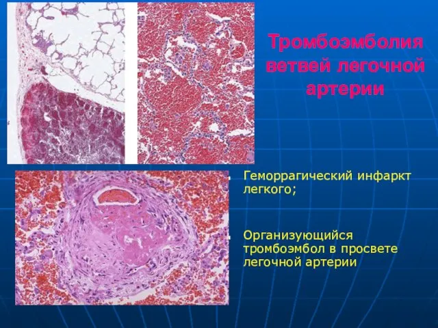 Тромбоэмболия ветвей легочной артерии Геморрагический инфаркт легкого; Организующийся тромбоэмбол в просвете легочной артерии