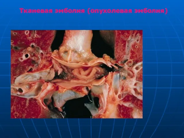 Тканевая эмболия (опухолевая эмболия)
