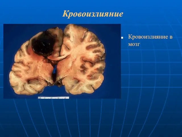 Кровоизлияние Кровоизлияние в мозг