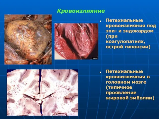 Кровоизлияние Петехиальные кровоизлияния под эпи- и эндокардом (при коагулопатиях, острой