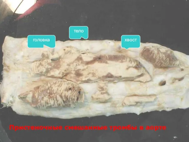 головка тело хвост Пристеночные смешанные тромбы в аорте Пристеночные смешанные тромбы в аорте
