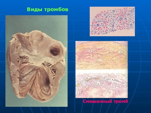 Виды тромбов Смешанный тромб