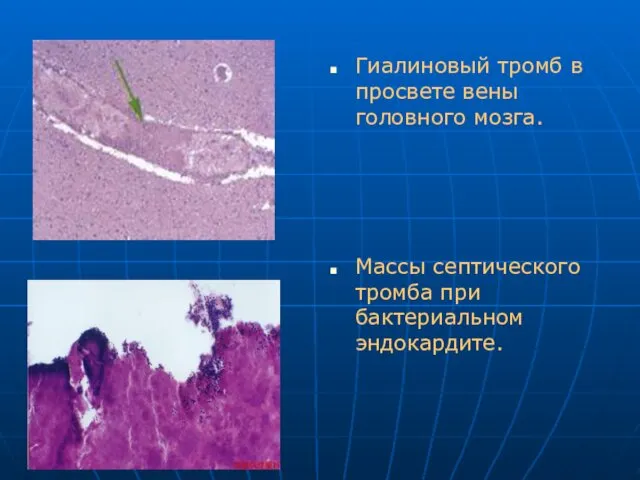 Гиалиновый тромб в просвете вены головного мозга. Массы септического тромба при бактериальном эндокардите.