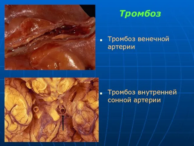 Тромбоз Тромбоз венечной артерии Тромбоз внутренней сонной артерии