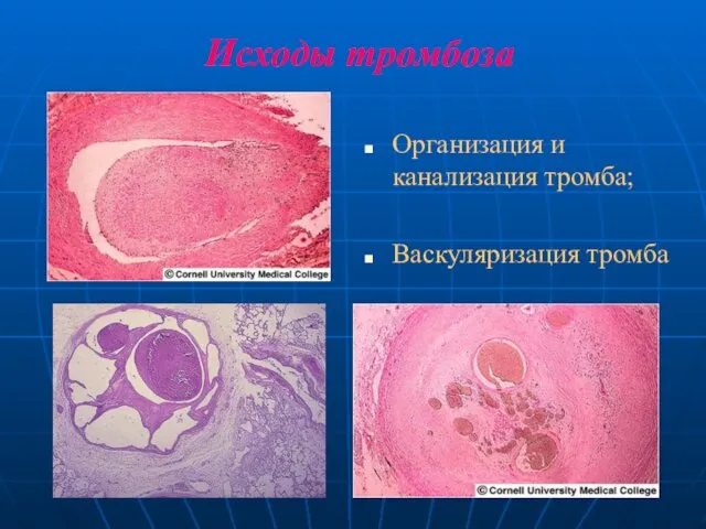 Исходы тромбоза Организация и канализация тромба; Васкуляризация тромба