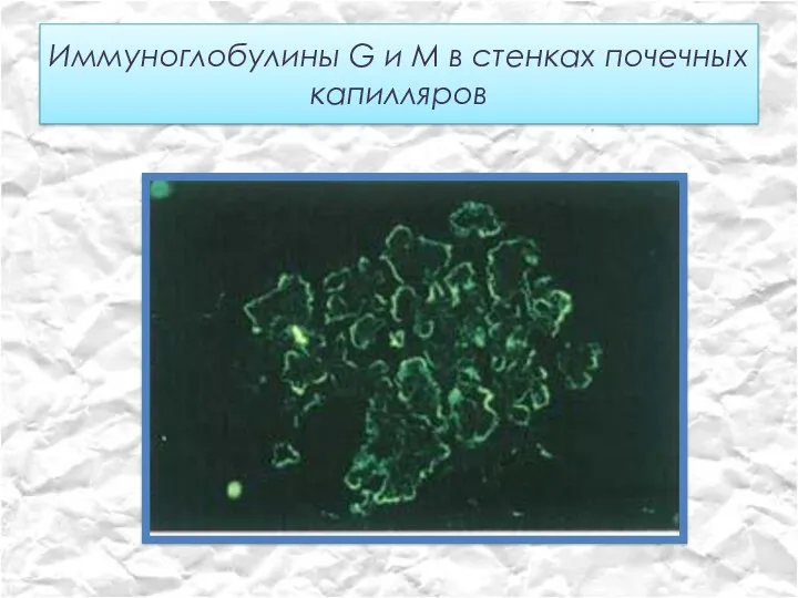 Иммуноглобулины G и М в стенках почечных капилляров